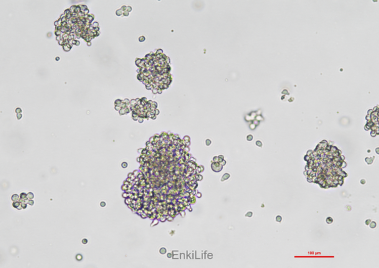 Natural killer cells NK-929 in patients with malignant non-Hodgkin lymphoma