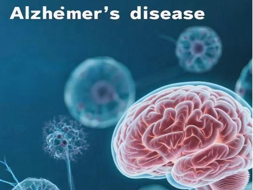  Alzheimer's disease (AD)