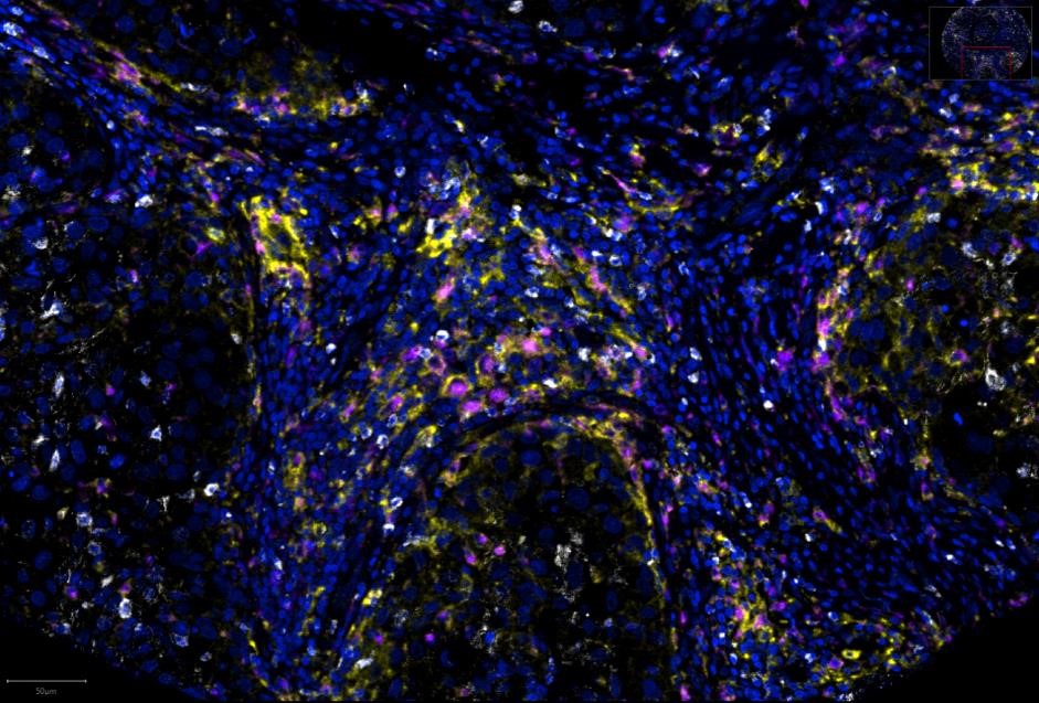 Literature Sharing: Multiplex Immunofluorescence Identifies High Stromal CD68⁺PD-L1⁺ Macrophages