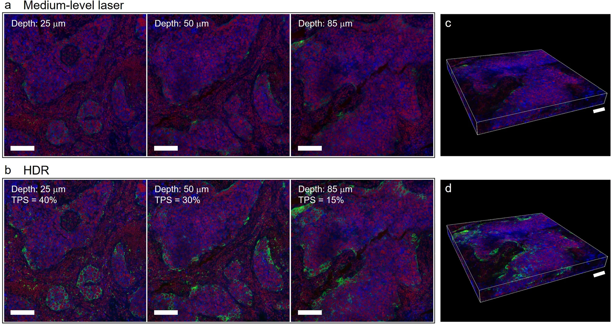 Literature Sharing: Multiplex Immunofluorescence Combined with HDR Imaging Enhances NSCLC PD-L1 3D Pathological Assessment