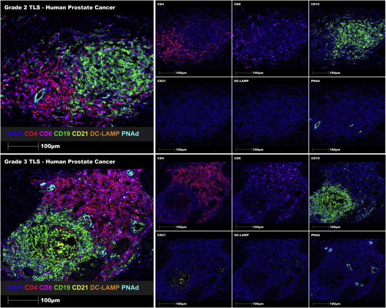 Literature Sharing: Application of Multiplex Immunofluorescence in the Study of Tumor Tertiary Lymphoid Structures