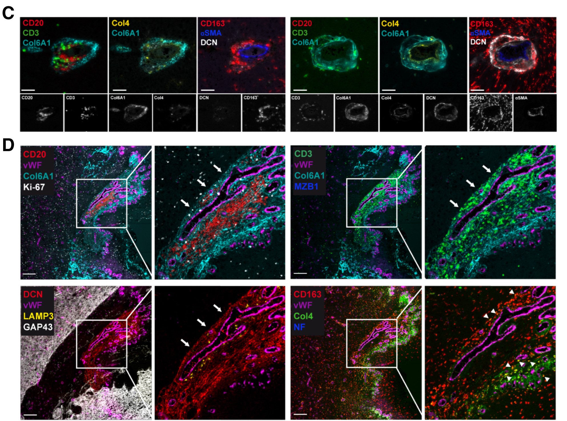 Literature Sharing: Spatial Resolution of Glioma Subgroups with Functional Tertiary Lymphoid Structures