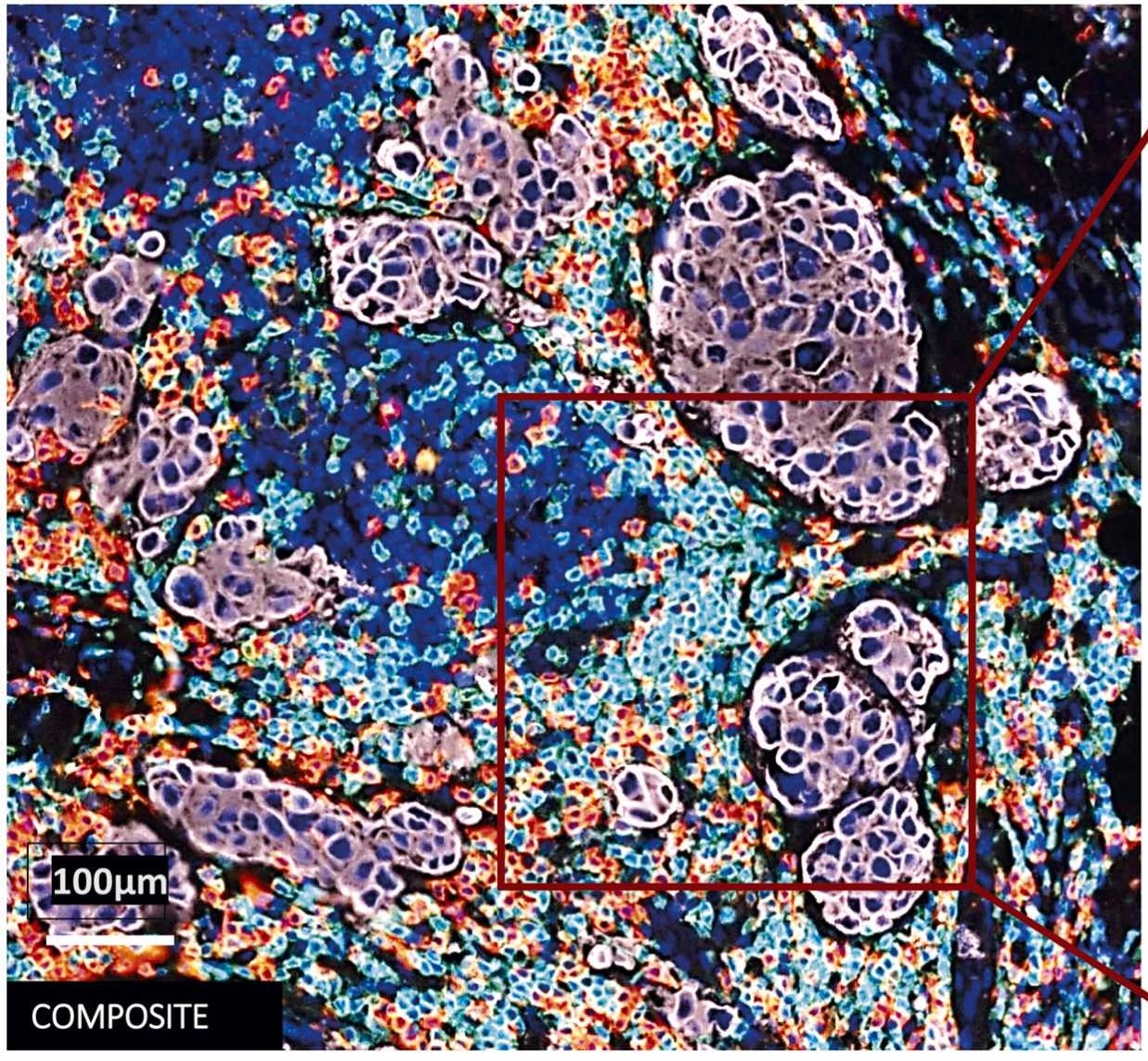 Literature Sharing: Multiplex Immunofluorescence Analysis of Early Triple-Negative Breast Cancer