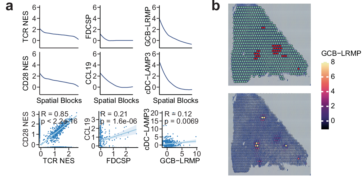 Literature Sharing: A Spatially Resolved Atlas of Gastric Cancer Reveals the Critical Role of Lymphocyte-Aggregated Regions