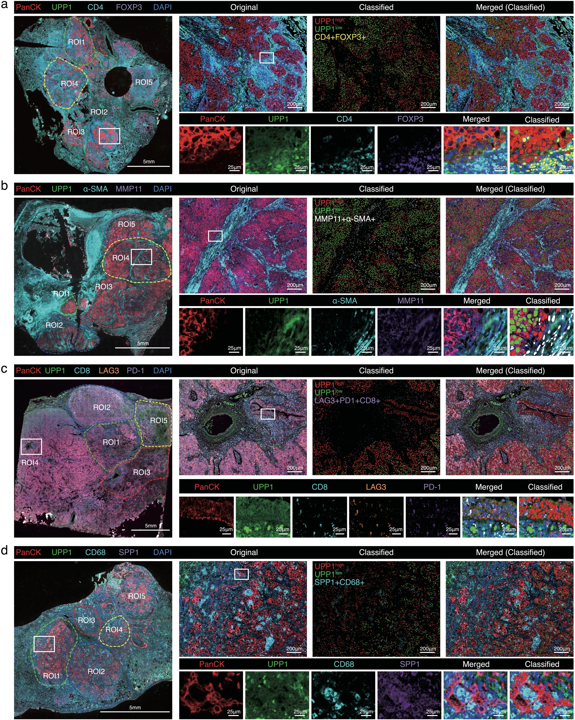 Metabolic Enzyme UPP1 How Does it Cross-Regulate Tumor Immunity?
