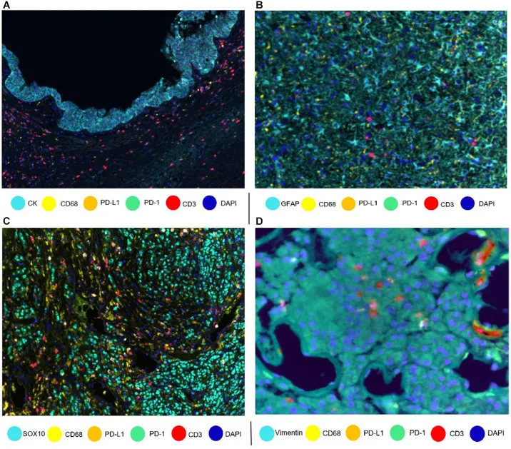 Literature Sharing: Multiplex Immunofluorescence – A New Approach for Tumor Immune Cell Atlas Detection