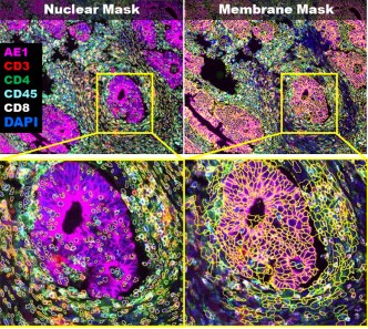 Literature Sharing: Multiplex Immunofluorescence Study Reveals PD1-Negative Regulatory T Cells as Prognostic Markers for Chemotherapy in Colorectal Cancer