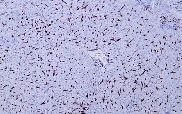 Hematolymphoid Markers