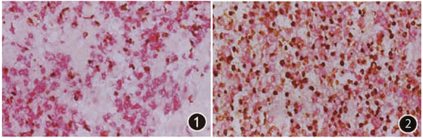 Analysis of Immunohistochemistry Double Staining Technology and Clinical Applications