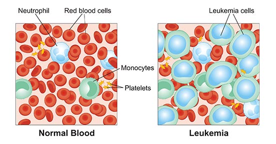 Leukemia: Prevalence, Development and Risk Factors