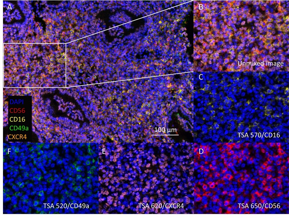 Evaluation of Uterine NK Cell Subtypes in the Peri‑Implantation Period Using mIHC for Repeated Implantation Failure