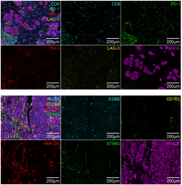 Multi‑dimensional TIIC Features: A Novel Predictive Tool for Anti‑PD‑1/PD‑L1 Therapy in Gastric Cancer