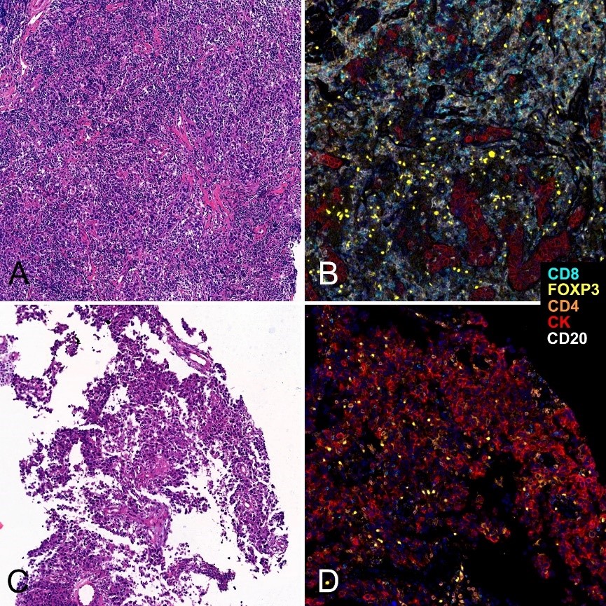 Literature Analysis: Decoding the Immune Microenvironment of TNBC After Neoadjuvant Chemotherapy Using mIF